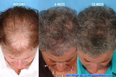Ny Times: Female Hair Loss Ny Times: Female Hair Loss - -