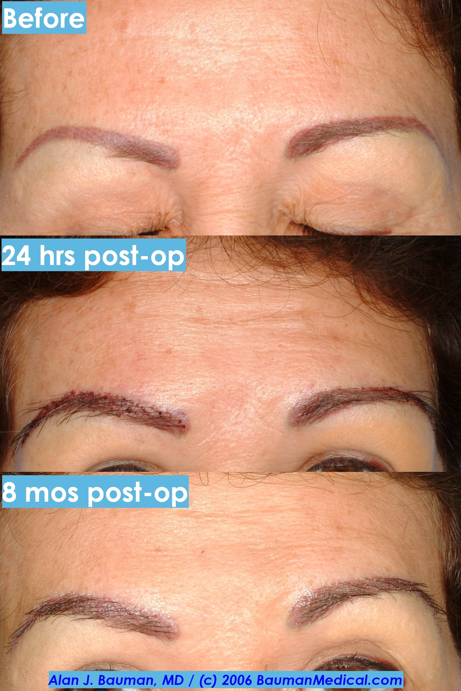 Eyebrow Scar Hair Transplant Before And After Eyebrow Transplant