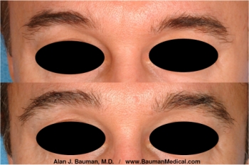 Eyebrow Scar Hair Transplant Before And After Male Eyebrow Transplant By Dr. Bauman (Click For Larger Photo) Eyebrow Transplant Transplantation By Dr Alan Bauman Florida Before After