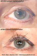 Eyelash Transplant Before & After (Alan J. Bauman, M.d.)
