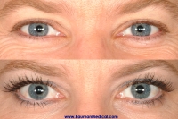 Especially For Women Bauman Patient, Lauren, Has Used An 'Eyelash Conditioner' For Several Months.