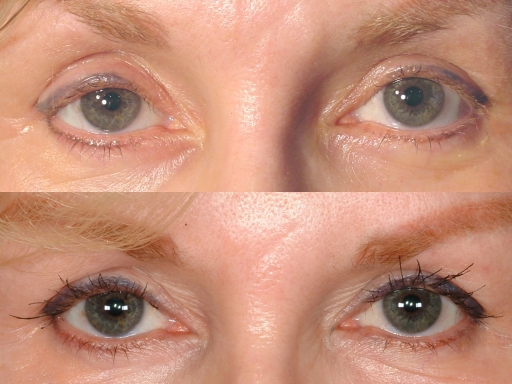 Eyelash Transplant And Implant Procedure Eyelash Transplant And Implant Procedure - -