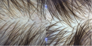 The Palm Beach Post &Quot;Hair: A Gift That Keeps Giving&Quot; Article Features Dr Bauman The Palm Beach Post - Accent - Healthy Living - December 25, 2012 “Hair: A Gift That Keeps Giving” - Noninvasive Therapy Restores Thinning Scalp By Steve Dorfman Quoting Dr. Bauman Article Photo