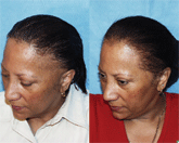 African-American-Female-Hair-Transplant-Side