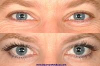Eyebrow, Eyelash, Scars, Etc. (Special Cases) Eyelash-Latisse-Before-After-Front