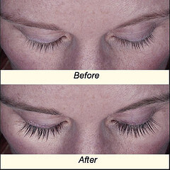 Eyebrow, Eyelash, Scars, Etc. (Special Cases) Eyelash-Latisse-Before-After