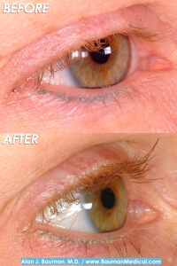 Eyelash Transplant And Implant Procedure Before And After Eyelash Transplant By Dr. Alan Bauman
