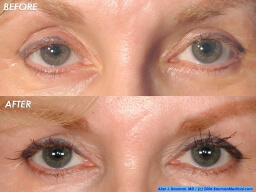 Eyebrow, Eyelash, Scars, Etc. (Special Cases) Eyelash-Transplant-Female-Elderly-Front