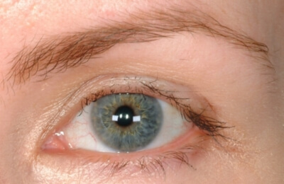 Eyelash Transplant And Implant Procedure Eyelashes-Damaged