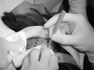 Hair Transplant Surgery Fue-Surgery