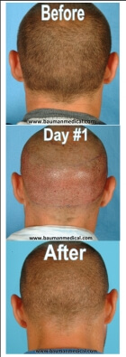 FUE-hair-donor-areas-before-after