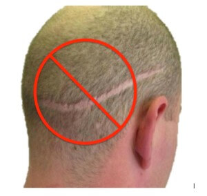 &Quot;Fue&Quot; - Follicular Unit Extraction With Neograft No Linear Scar Fue Hair Transplant