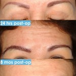 Eyebrow Transplant Procedure Eyebrow Transplant Procedure