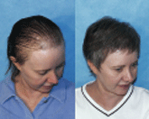 Female-Hair-Transplant-Side