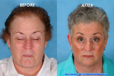 &Quot;Joan&Quot; Female Hair Transplant Female-Hair-Transplantation-Front