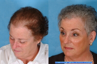 &Quot;Joan&Quot; Female Hair Transplant Female-Hair-Transplantation-Side-Before-After