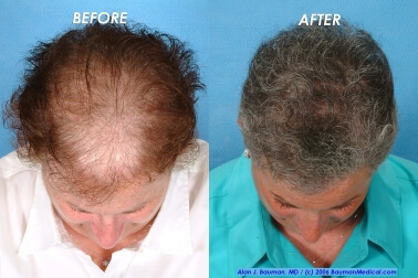 Female-Hair-Transplantation-Top