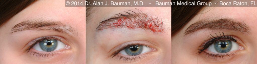 Eyebrow Scar Hair Transplant Female-Eyebrow-Transplant-Scar_Dralanbauman_Pre+24Hr+12Mo