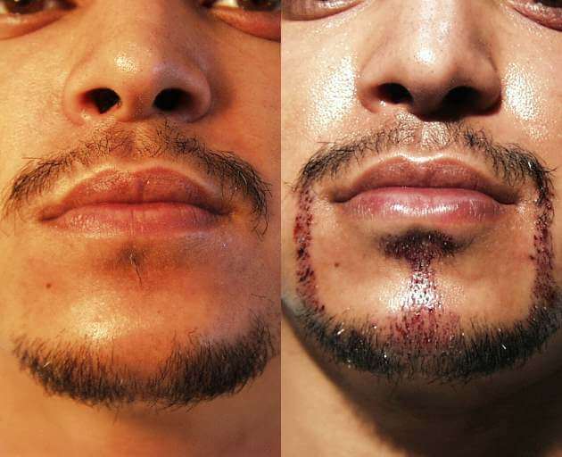 Eyebrow, Eyelash, Scars, Etc. (Special Cases) Goatee-Hair-Transplant
