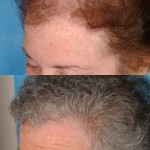 &Quot;Joan&Quot; Female Hair Transplant Hair-Transplant-Female-Before-After-Left-Side