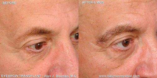 Eyebrow Patient Profiles Male-Eyebrow-Transplant-Closeup