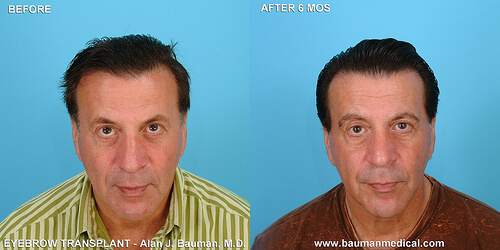 Eyebrow Patient Profiles Male-Eyebrow-Transplant-Front