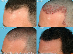 Hair Transplant Surgery Male-Neograft-Before-After
