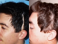 Eyebrow, Eyelash, Scars, Etc. (Special Cases) Scar-Hair-Repair