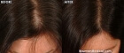 Womens-Hair-Restoration-Before-After