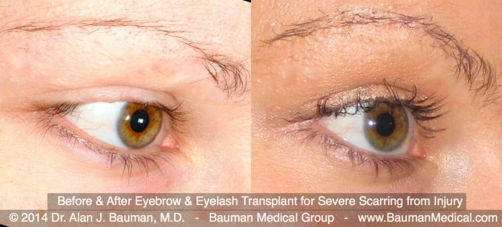 Eyebrow Scar Hair Transplant Eyebrow+Eyelash-Scar-Transplant_Dralanbauman