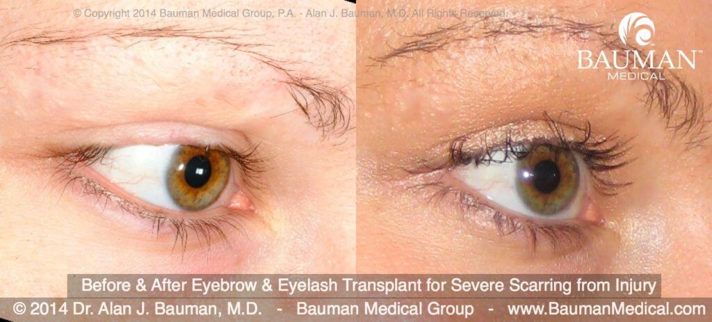 Eyelash Transplant And Implant Procedure Before After Eyelash Eyebrow Scar Transplant Implant Dr Alan Bauman