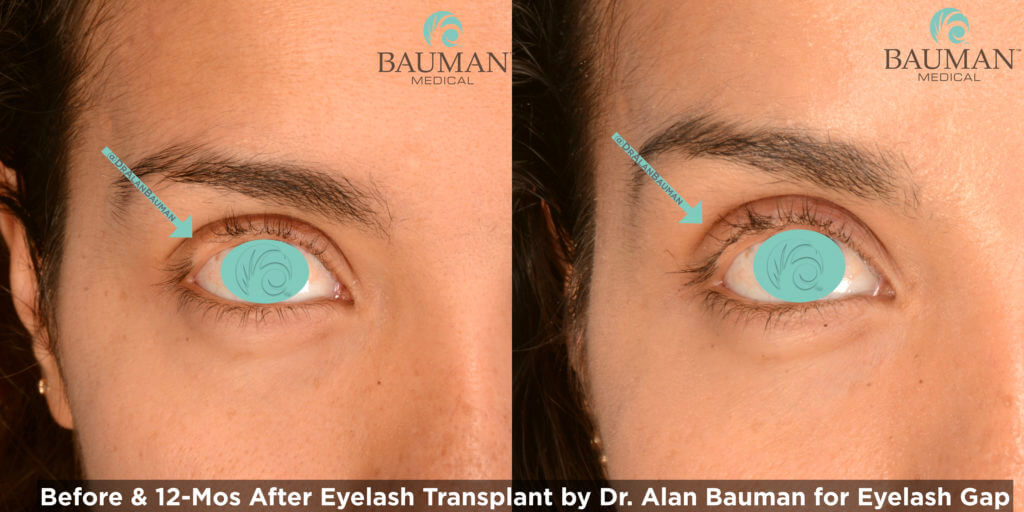 Eyelash Transplant And Implant Procedure Eyelash-Gap-Photos-Before-After Eyelash Transplant