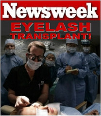 Eyelash Transplant And Implant Procedure Dr. Alan Bauman'S Eyelash Transplant Featured In Newsweek