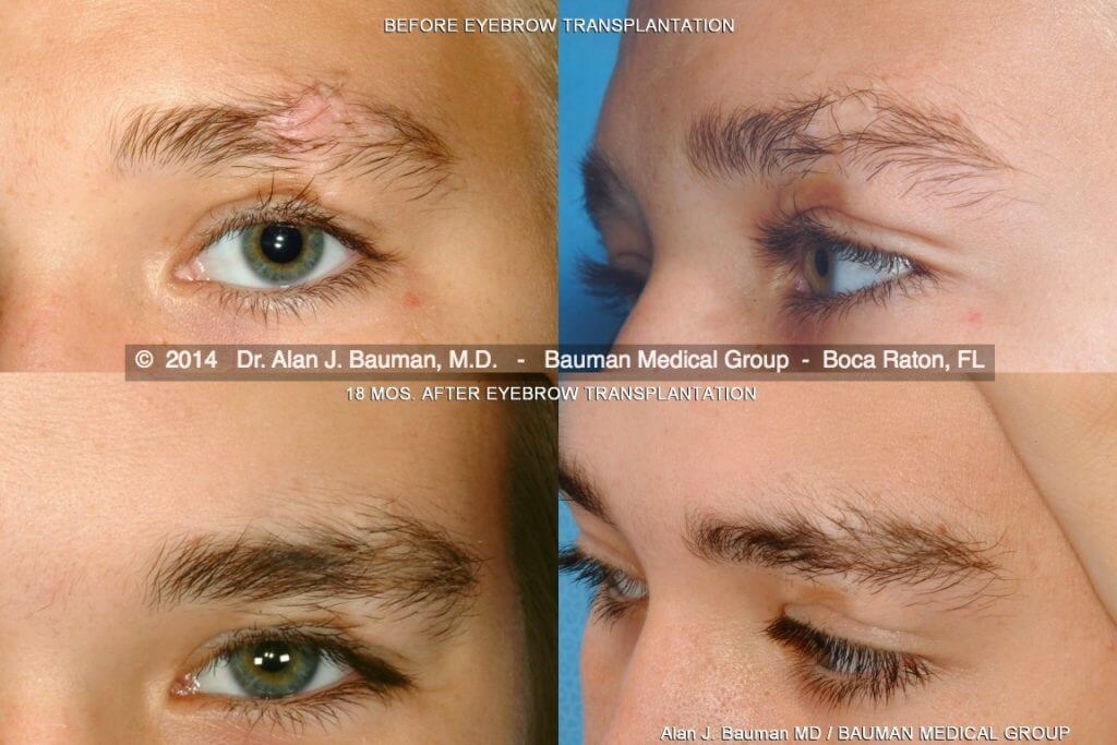 Eyebrow Scar Hair Transplant Male-Eyebrow-Scar-Transplant-Dralanbauman Eyebrow Transplant Transplantation Scar By Dr Alan Bauman Florida Before After