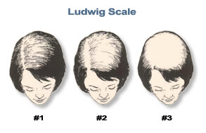 Hair Loss 101: Start Here Ludwig Scale For ≪A Href=