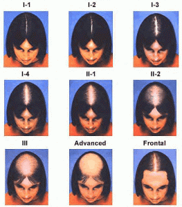 Hair Loss 101: Start Here Savin Scale For ≪A Href=