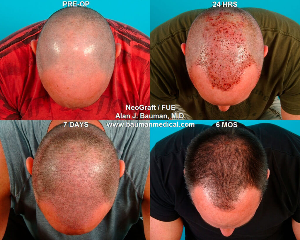 Neograft Fue Hair Transplant In Florida Neograft-Fue-Hair-Treatment-In-Florida