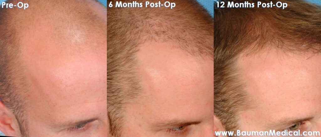 Neograft Fue Hair Transplant In Florida Neograft-Fue-Florida