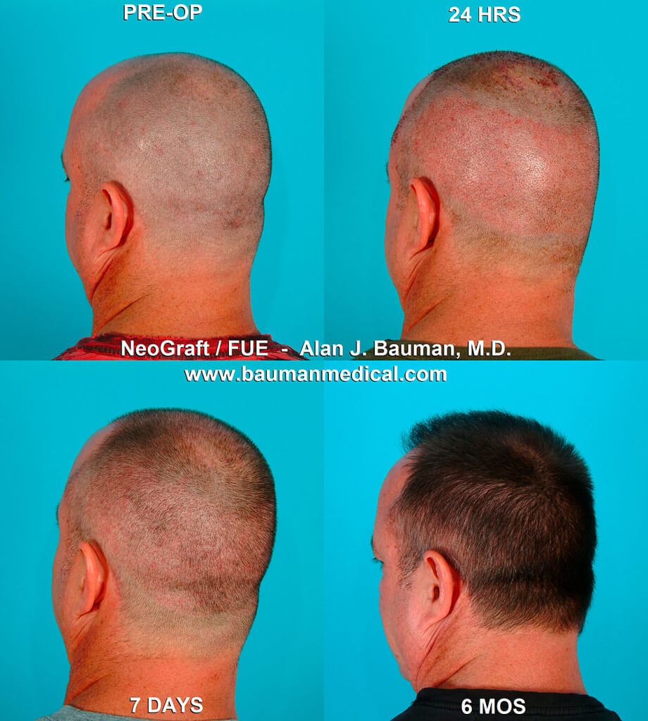 Neograft Fue Hair Transplant In Florida Neograft-Fue-Hair-Transplant