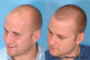 Temporal Point Restoration Photos: Hair Transplant Artistry Bald-Head-Hair-Restoration