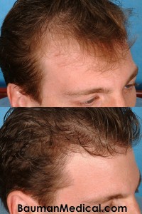 Temporal Point Restoration Photos: Hair Transplant Artistry Before-Temporal-Hair-Restoration