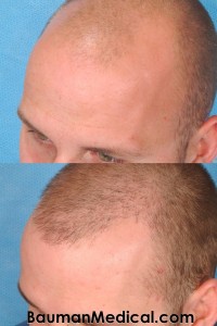 Temporal Point Restoration Photos: Hair Transplant Artistry Beforehairrestoration