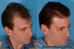 Temporal Point Restoration Photos: Hair Transplant Artistry Hair-Restoration-Before-And-After