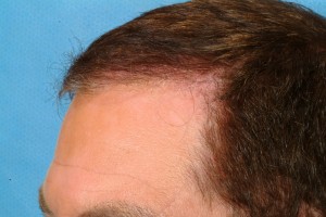 Hair-Restoration-Jim-Abath-Hairline