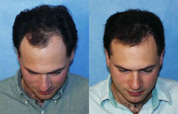 Patient Profile Hair-Transfer-Before-And-After