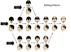 Hair Loss 101: Start Here Norwood_Hamilton_Baldness_Scale_Bauman-Medical