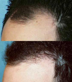 Patient Profile Patient-Picture-Hair-Graft-Transfer