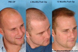 Temporal Point Restoration Photos: Hair Transplant Artistry Stageofhairrestoration-Dr-Bauman