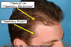 Temporal Point Restoration Photos: Hair Transplant Artistry Temporal-Point-Hair-Restoration