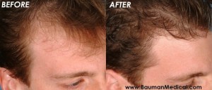 Temporal Point Restoration Photos: Hair Transplant Artistry Temporal-Point-Hair-Restoration2
